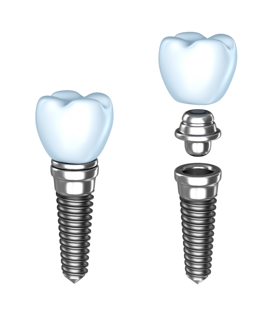 https://auroradentalimplant.com/wp-content/uploads/2022/08/dental-implant-model-1-1-907x1030-1.png